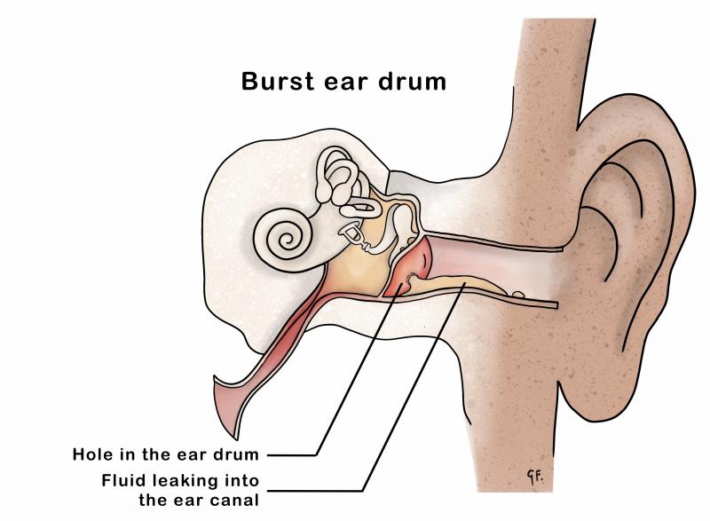 ear-infections-in-detail-kidshealth-nz